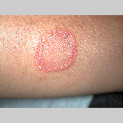 treatment for ringworm. whd ringworm Medication