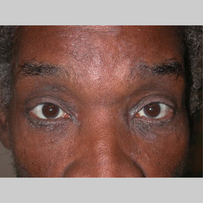 Eyelid Dermatitis Treatment and Symptoms - Seborrheic ...