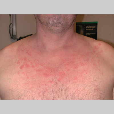 seborrheic dermatitis on chest #10