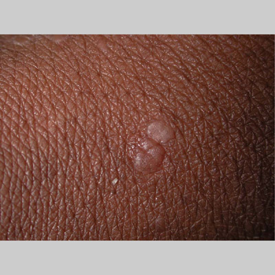 Flat Warts