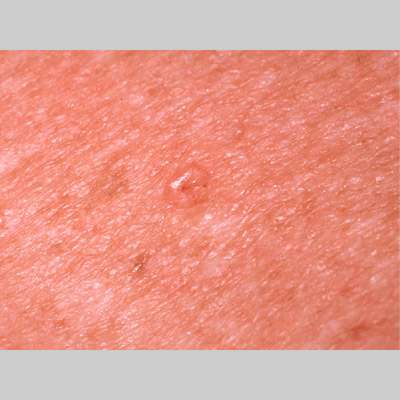 Melanoma: MedlinePlus Medical Encyclopedia