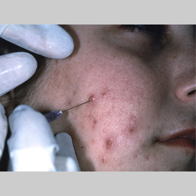 Intralesional corticosteroid injection for acne