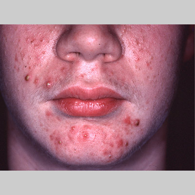 Image #444: acne Image #444: acne