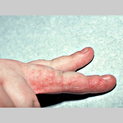 Hand symptoms and Scaly skin - Symptom Checker