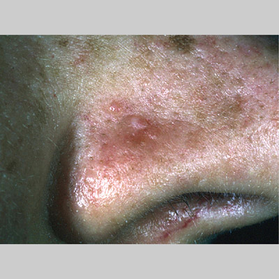 General dermatology - morphology | Primary Care ...