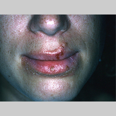 Herpes+simplex+1+on+lips