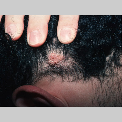 wart on scalp