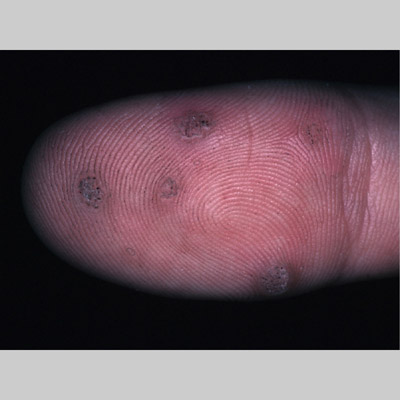 common warts on legs. common warts on fingers. warts