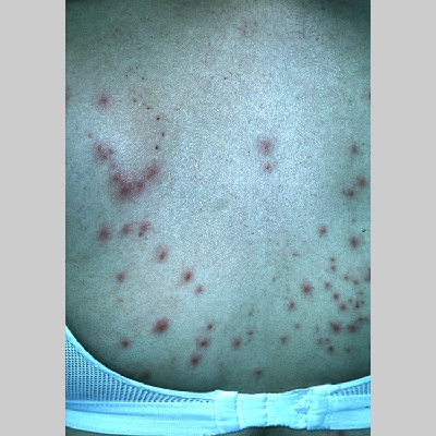 Ciprofloxacin to treat pseudomonas rash Ciprofloxacin to treat pseudomonas rash