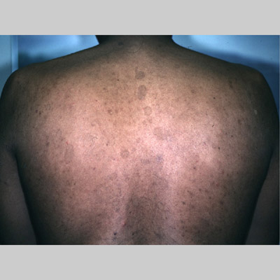 PITYRIASIS VERSICOLOR - British Association of...