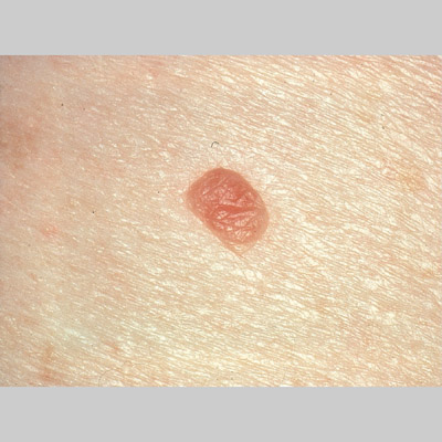 Dermal nevus | Dermpedia