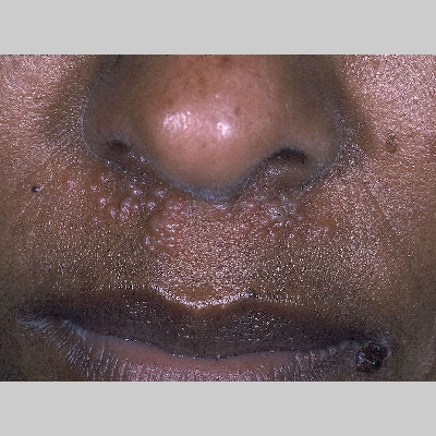 herpes simplex on face #11