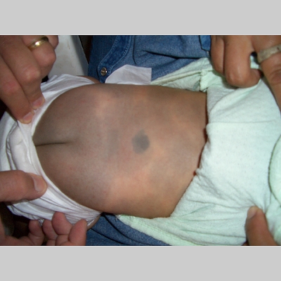 Congenital Dermal Melanocytosis (Mongolian Spot ...