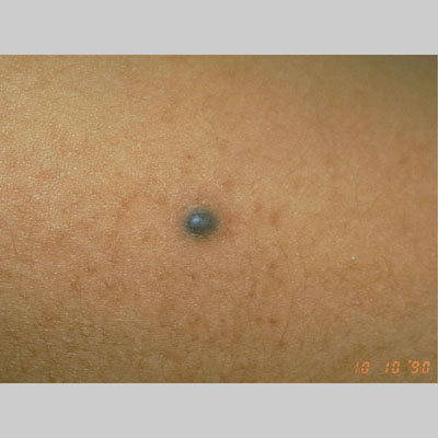 Dermnet: Dermatology Pictures - Skin Disease Pictures