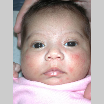 INFANT ACNE infant acne: