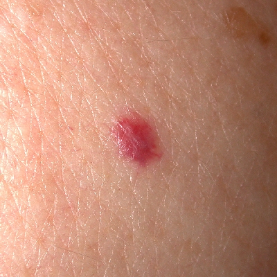 On my chest I have a small 2 to 3 mm spot red. In certain lights it
