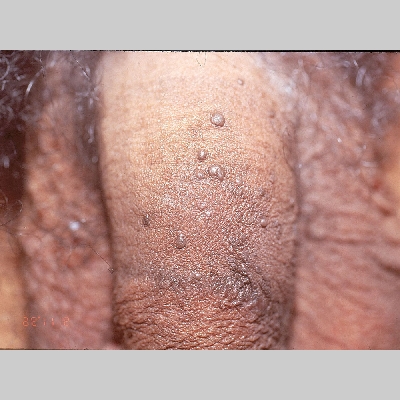 Genital warts pictures black male