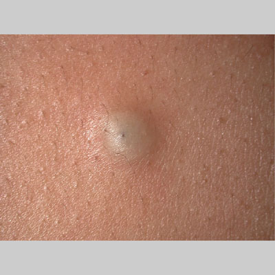 Picture of Epidermal Inclusion Cyst (EIC) on MedicineNet