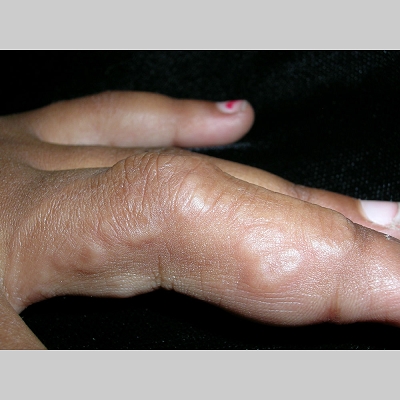 Erythema Annulare Centrifugum - Medscape Reference