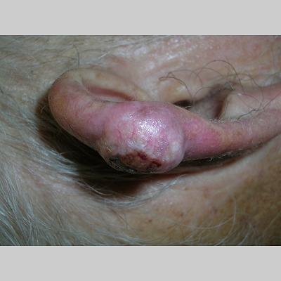 Keratoacanthoma Ear