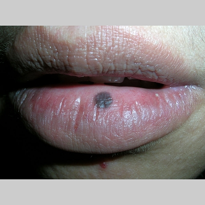 Oral Melanotic Macules 66