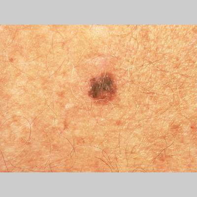 Melanoma: MedlinePlus Medical Encyclopedia