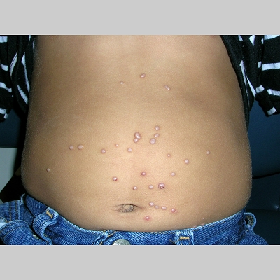 molluscum contagiosum behandling molluscum contagiosum behandling