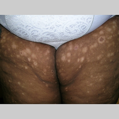 Steroid hypopigmentation treatment