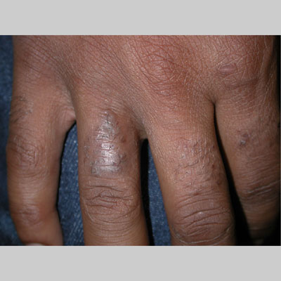 Steroid treatment for contact dermatitis