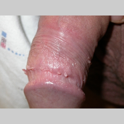 Genital Warts (HPV) Picture Image on MedicineNet.com