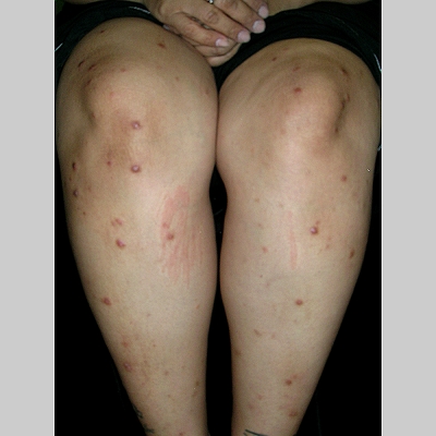Nodular Prurigo Pictures