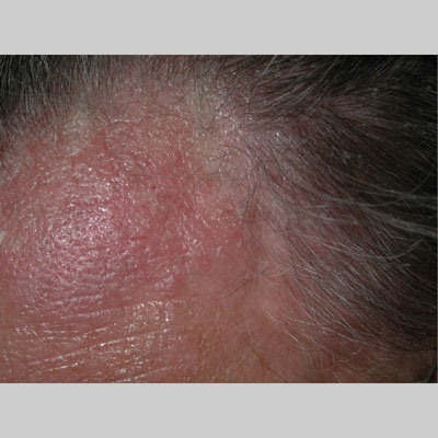 Seborrheic Dermatitis | National Eczema Association