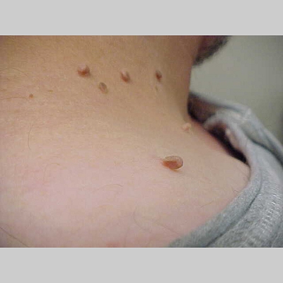 Skin Tags (Acrochordon) - Prevention