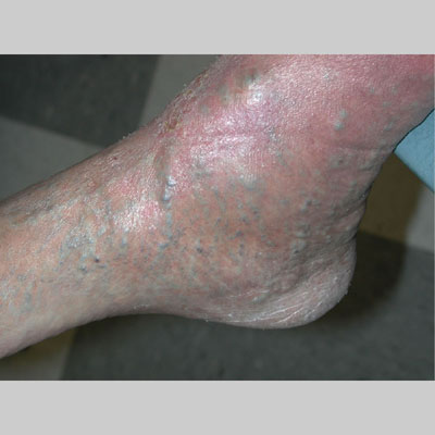 Dermnet: Dermatology Pictures - Skin Disease Pictures