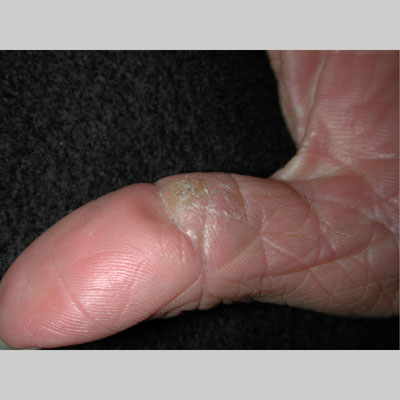 common wart images. common common warts on