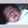 Acne Neonatal