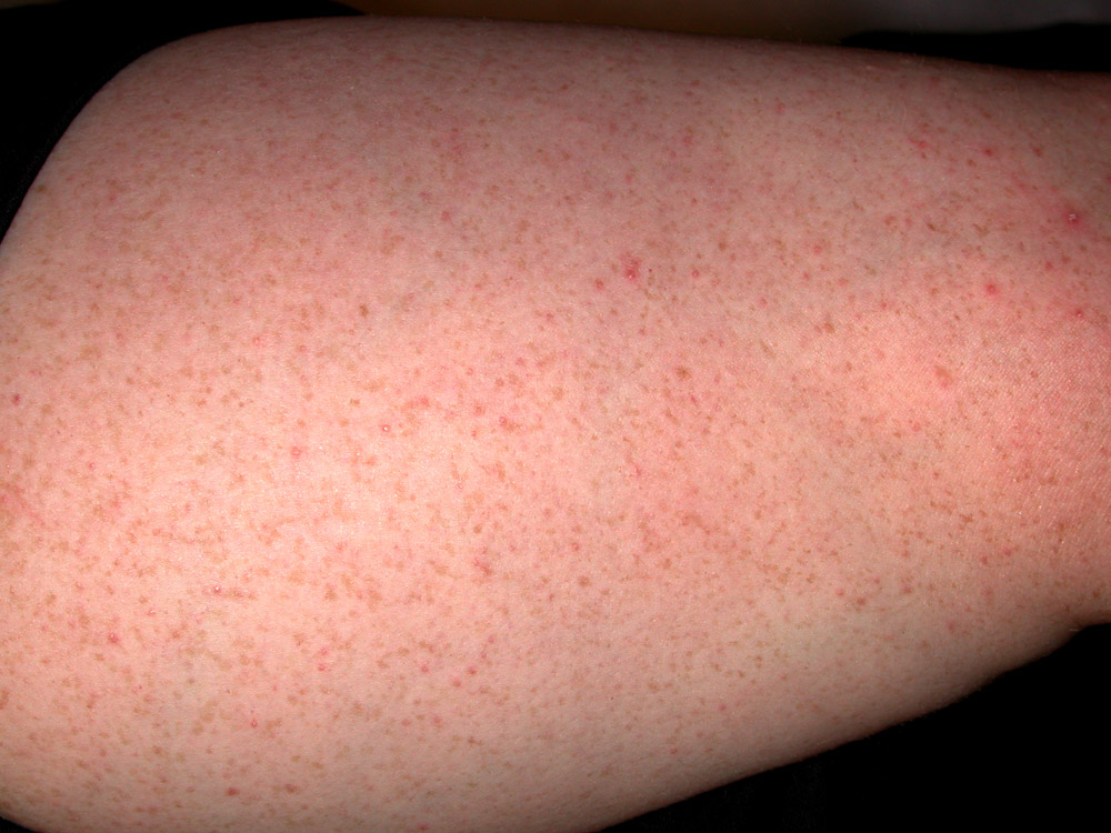 keratosis pilaris
