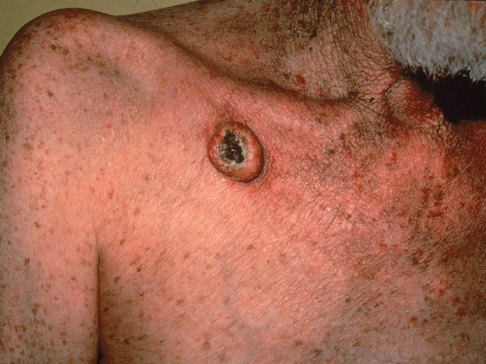 keratoacanthoma