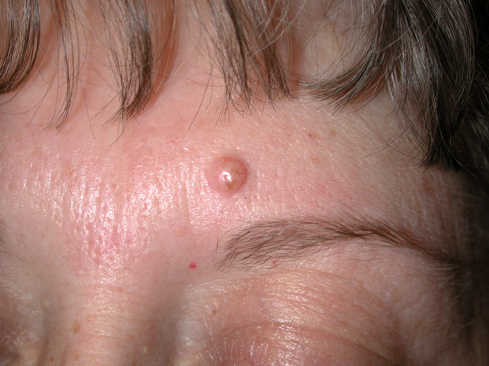 nevus, dermal
