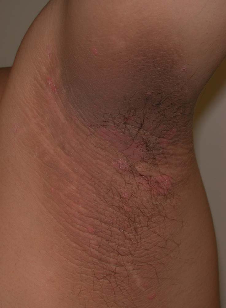 acanthosis nigricans