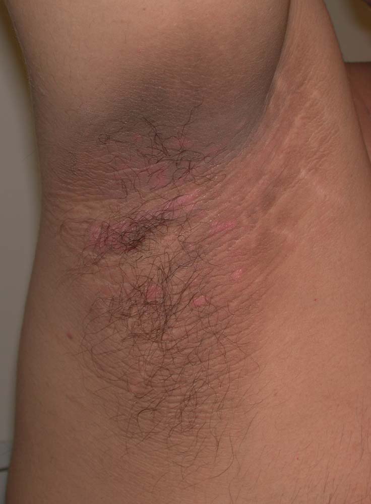 acanthosis nigricans