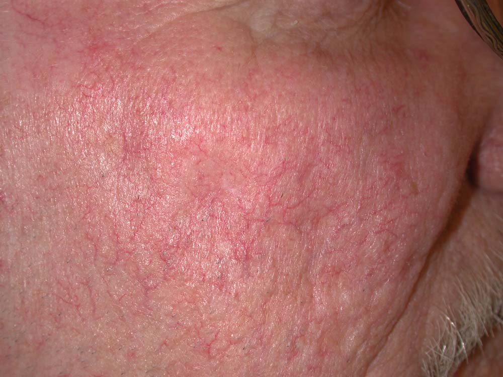 angioma
