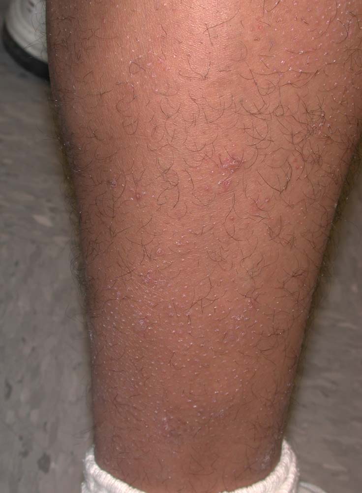 keratosis pilaris