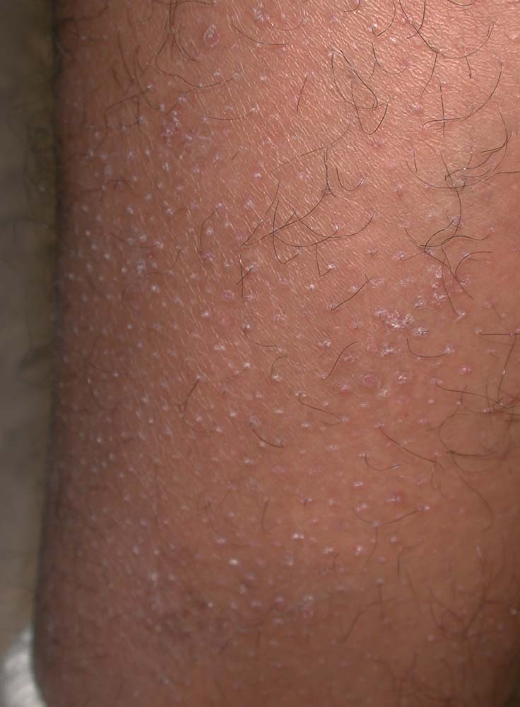keratosis pilaris
