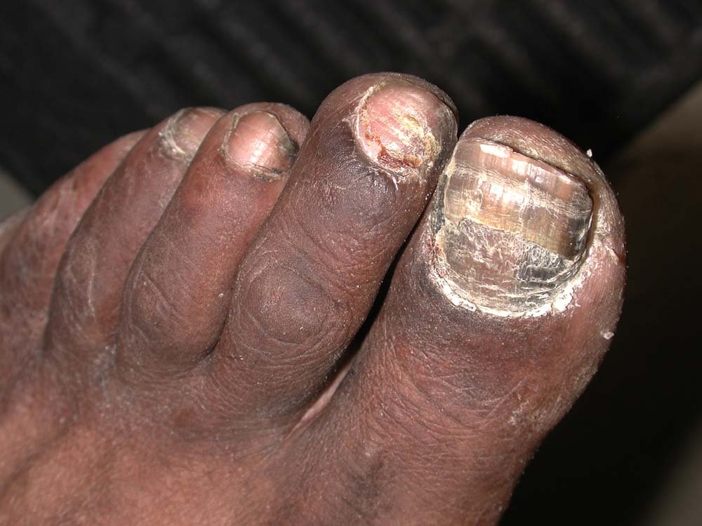 onychomycosis