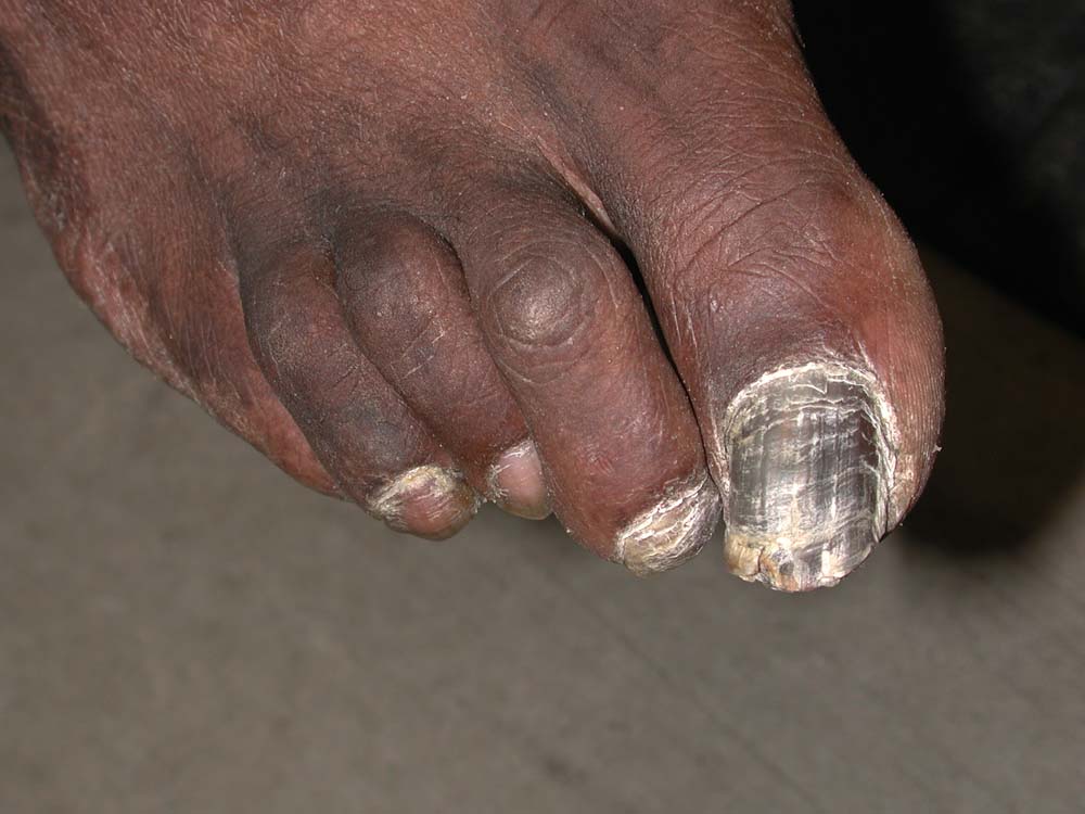 onychomycosis