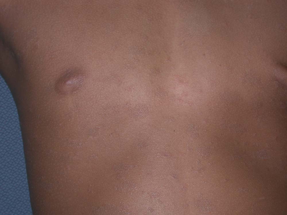 pityriasis rosea