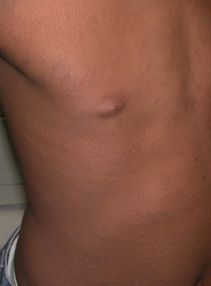pityriasis rosea