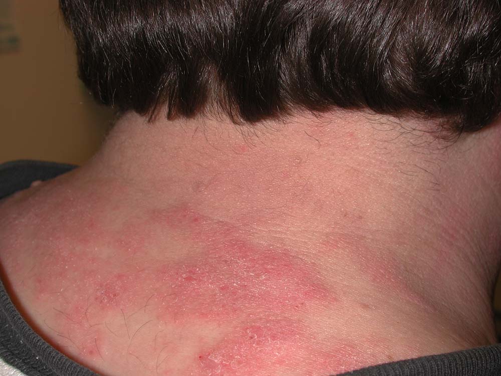 psoriasis