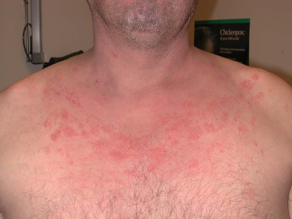 psoriasis